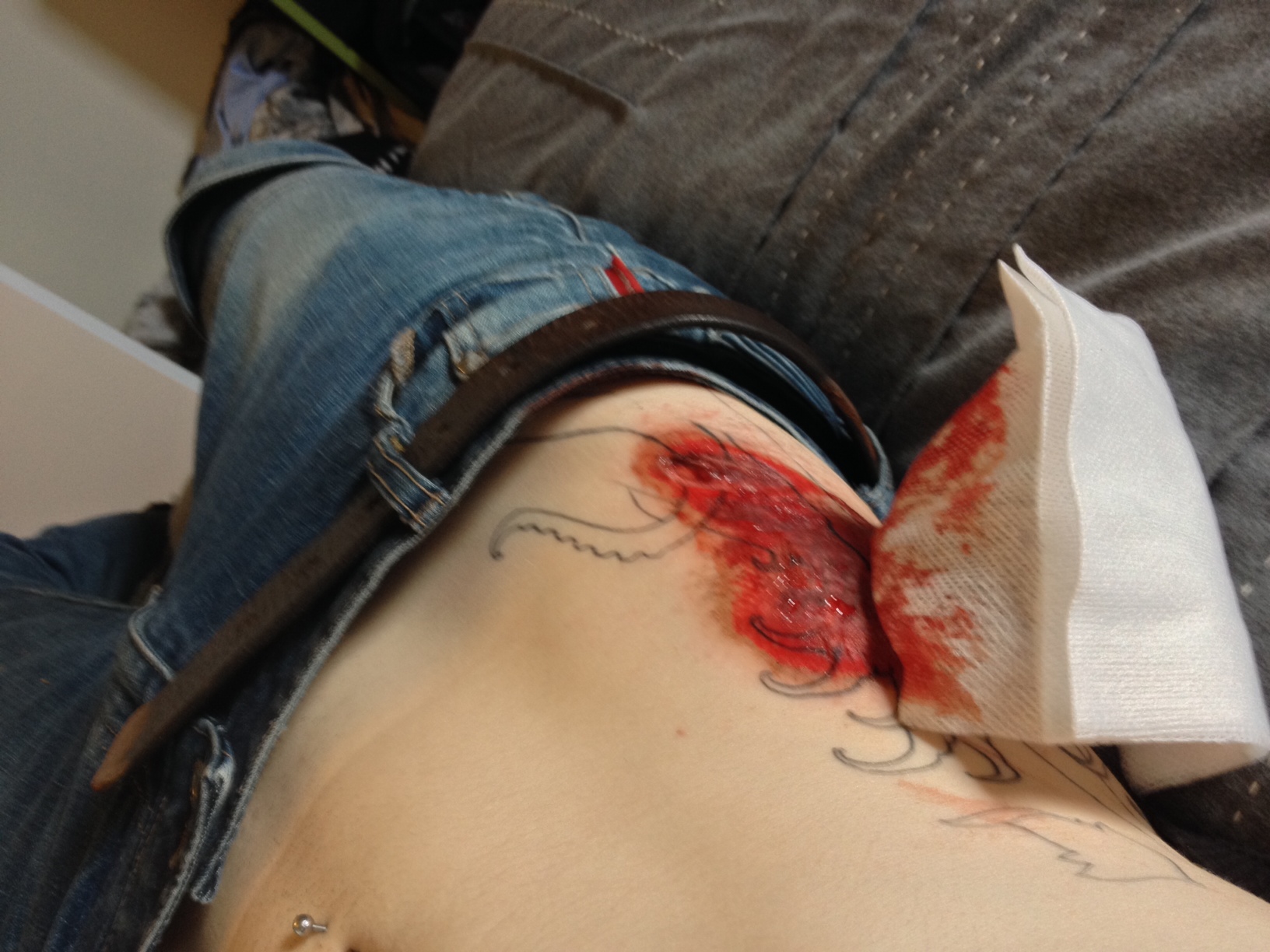 road rash from motorcycle accident