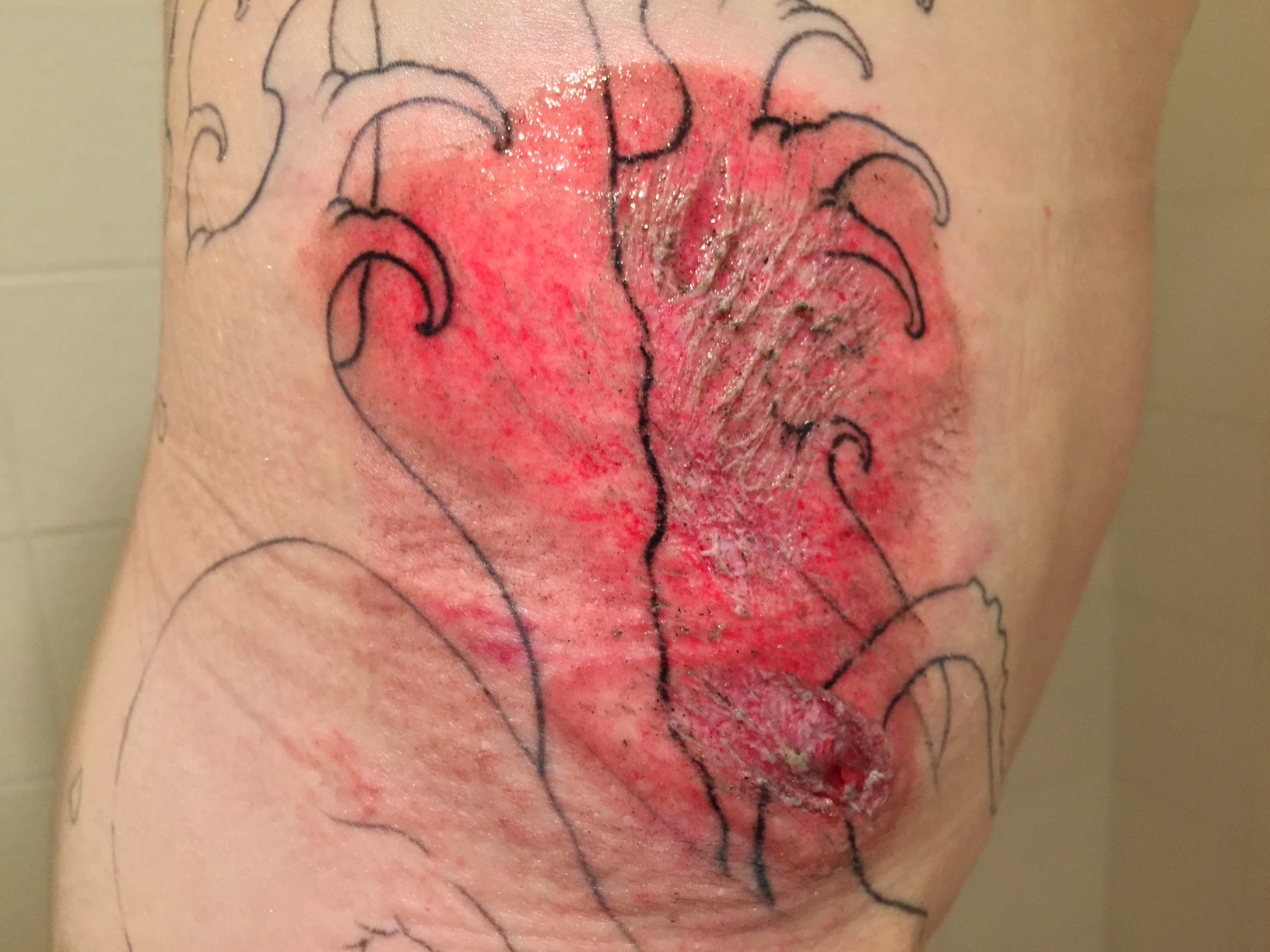 Road rash after first big cleaning, night of crash
